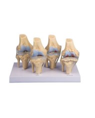 Erler Zimmer, modello anatomico di 4 stadi dell'artrite del ginocchio