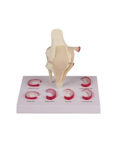Erler Zimmer, modello anatomico di menisco lesionato con versamento 4580 Erler Zimmer, modello anatomico di menisco lesionato con versamento 4580