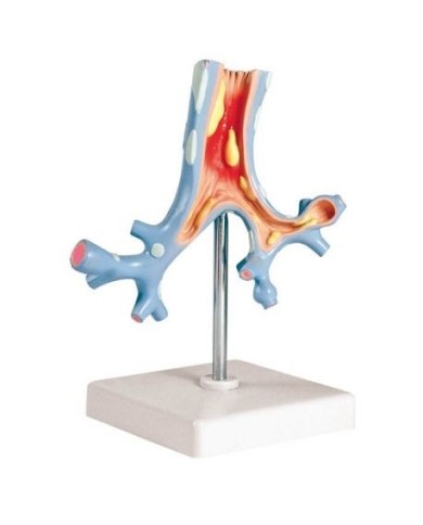 Erler Zimmer, modello anatomico didattico di patologie dei bronchi G151