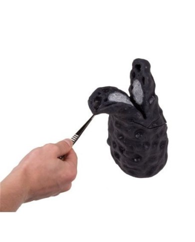 Erler Zimmer, modello anatomico didattico di cancro ai polmoni