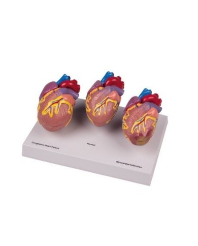 Erler Zimmer, modello anatomico di malattie del cuore, scomponibile in 6 parti G70 Erler Zimmer, modello anatomico di malattie del cuore, scomponibile in 6 parti G70