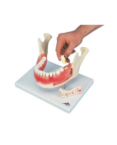 3B Scientific, modello anatomico di patologie dentali, ingrandito 2 volte, 21 pezzi D26