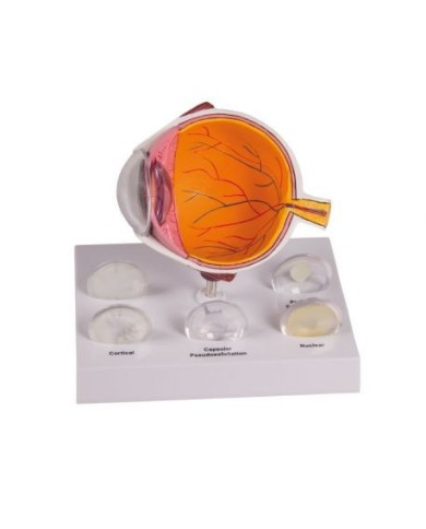 Erler Zimmer,  modello anatomico di 'occhio con cataratta, ingrandito F80