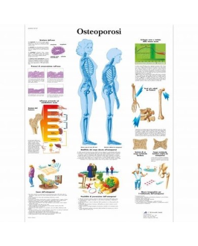 3B Scientific, tavola anatomica, Poster Osteoporosi (cod. VR4121UU) 3B Scientific, tavola anatomica, Poster Osteoporosi (cod. VR4121UU)