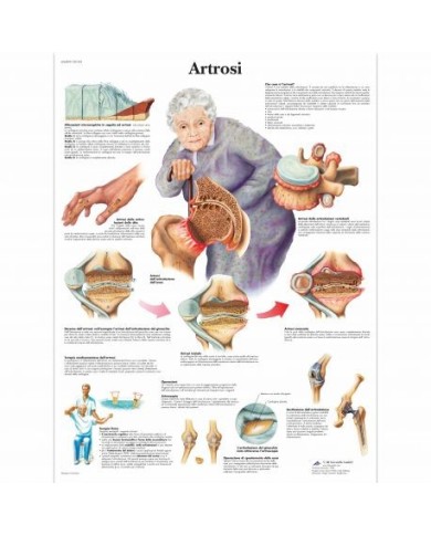 3B Scientific, tavola anatomica, Poster Artrosi  (cod. VR4123L) 3B Scientific, tavola anatomica, Poster Artrosi  (cod. VR4123L)