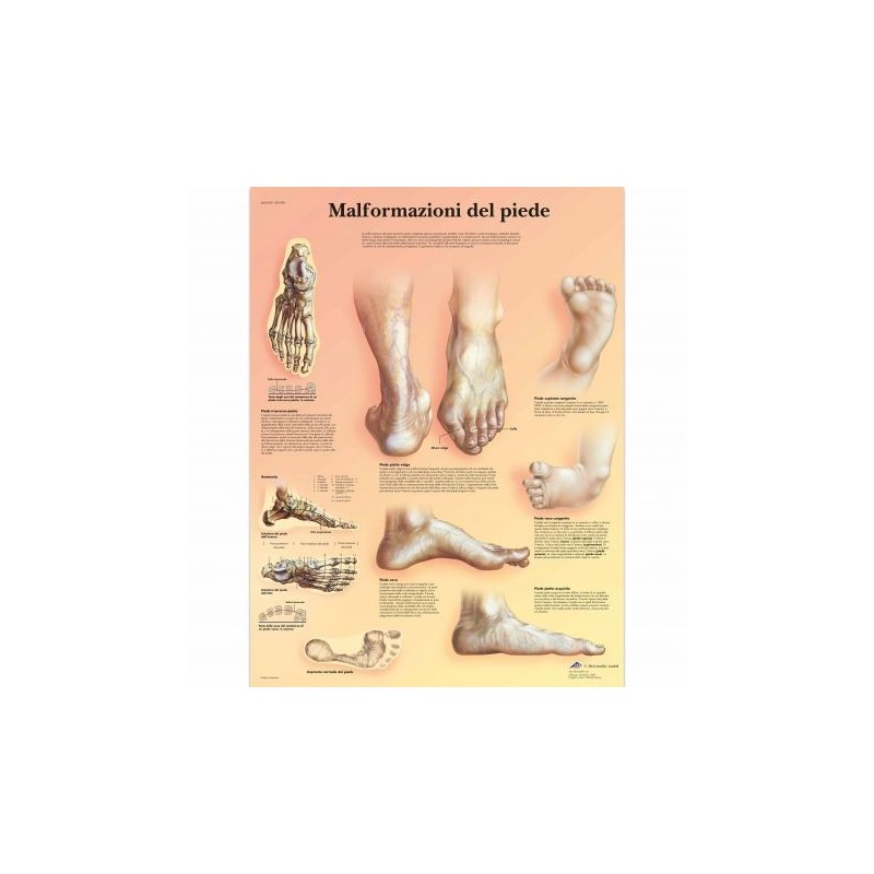 3B Scientific, tavola anatomica, Poster Malformazioni di piede (cod. VR4185L)