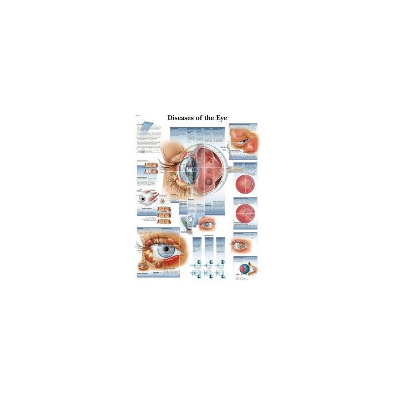 3B Scientific, tavola anatomica, Poster malattie dell'occhio (cod. VR4231UU)