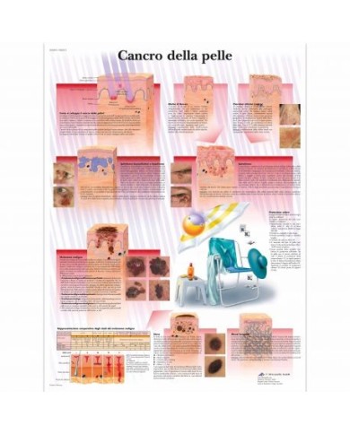 3B Scientific, tavola anatomica, Poster Cancro della pelle (cod. VR4295L) 3B Scientific, tavola anatomica, Poster Cancro della pelle (cod. VR4295L)
