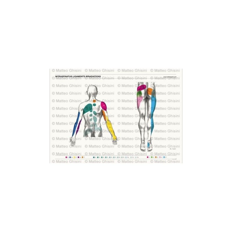 Osteoposter - Irradiazione Legamenti Interspinosi Dorsale