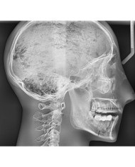 Simulatore per radiologia - Cranio con vertebre cervicali - Trasparente - Erler Zimmer 7300