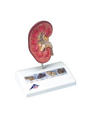 Modello anatomico di rene con calcoli renali, 3B Scientific K29