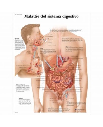 3B Scientific, tavola anatomica, Malattie del sistema digestivo (cod, VR4431UU) 3B Scientific, tavola anatomica, Malattie del sistema digestivo (cod, VR4431UU)