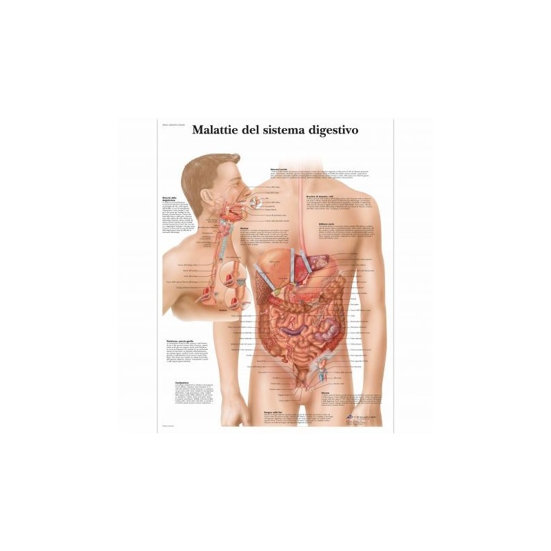 3B Scientific, tavola anatomica, Malattie del sistema digestivo (cod, VR4431UU)