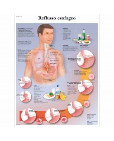 3B Scientific, tavola anatomica, Reflusso esofageo (cod, VR4711UU) 3B Scientific, tavola anatomica, Reflusso esofageo (cod, VR4711UU)