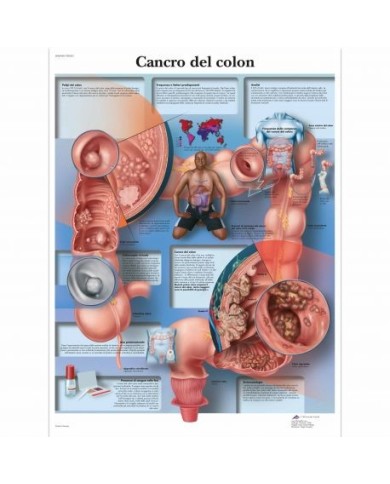 3B Scientific, tavola anatomica, Poster Cancro del Colon cod. VR4432L 3B Scientific, tavola anatomica, Poster Cancro del Colon cod. VR4432L