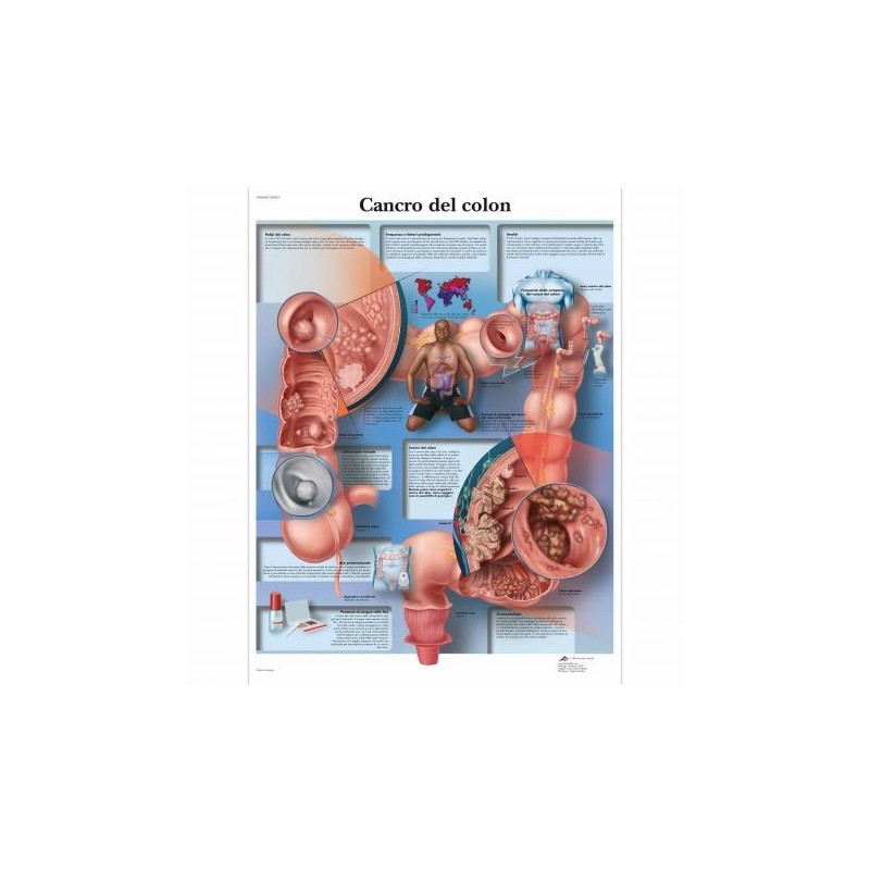 3B Scientific, tavola anatomica, Poster Cancro del Colon cod. VR4432L