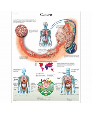 3B Scientific, tavola anatomica, Poster Cancro cod. VR4753L 3B Scientific, tavola anatomica, Poster Cancro cod. VR4753L