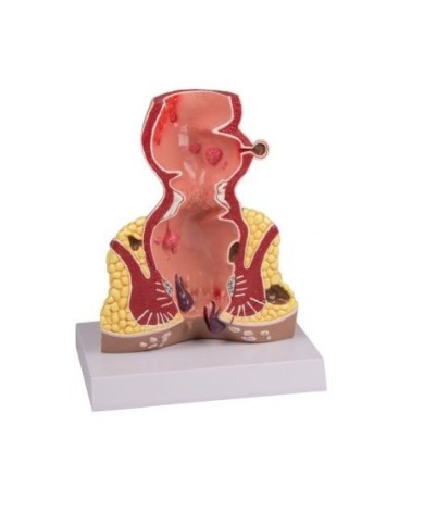 Erler Zimmer, Intestino retto con patologie, ingrandito 1,5 volte , K90