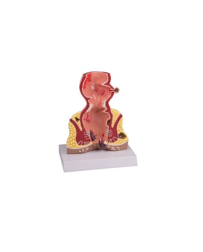 Erler Zimmer, Intestino retto con patologie, ingrandito 1,5 volte , K90