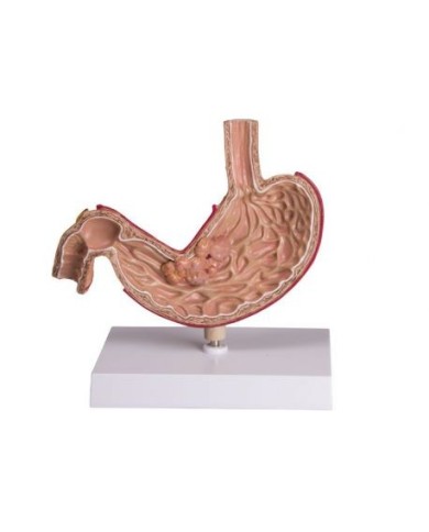 Erler Zimmer, modello anatomico di stomaco umano con cancro K83