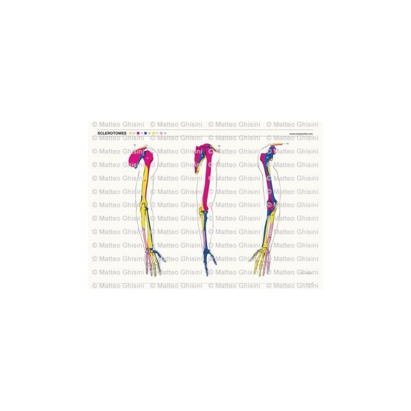 Osteoposter - Sclerotomi Braccia