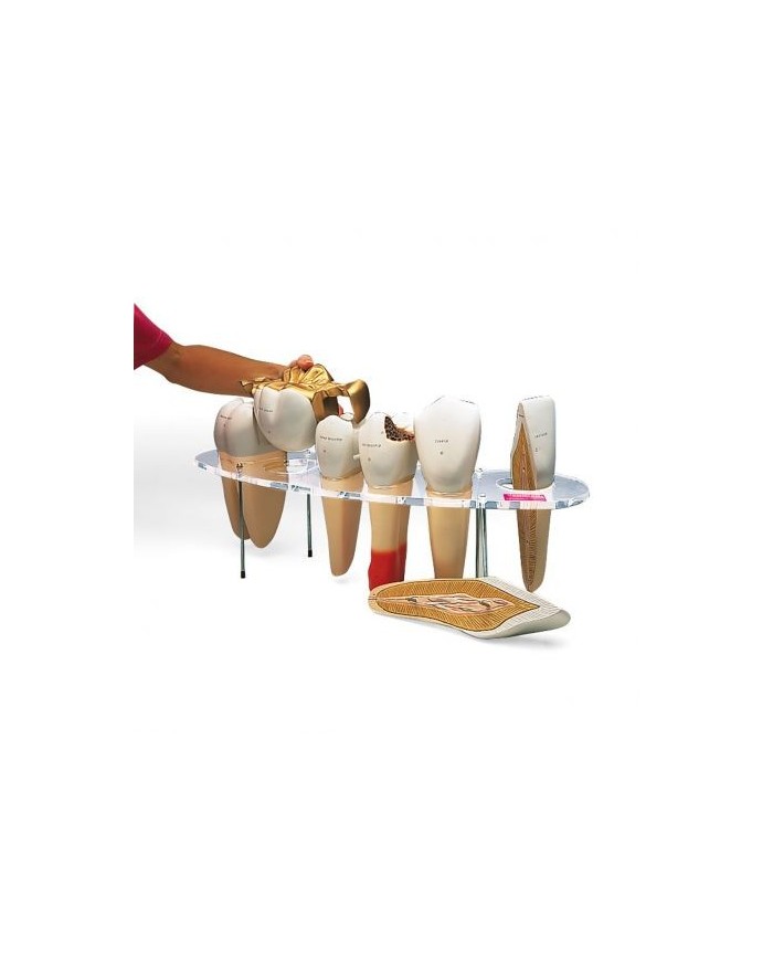 3B Scientific, modello anatomico di protesi dentaria, ingrandito 10 volte, in 7 parti W42517