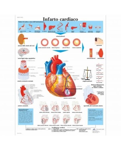 3B Scientific, tavola anatomica, Infarto Cardiaco (cod, VR4342L) 3B Scientific, tavola anatomica, Infarto Cardiaco (cod, VR4342L)