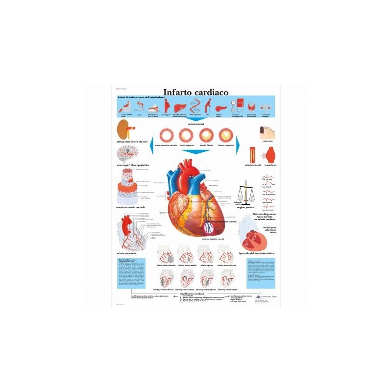 3B Scientific, tavola anatomica, Infarto Cardiaco (cod, VR4342L)