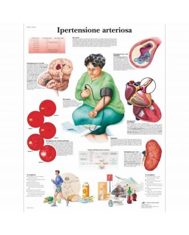 3B Scientific, tavola anatomica, Ipertensione Arteriosa (cod, VR4361L) 3B Scientific, tavola anatomica, Ipertensione Arteriosa (cod, VR4361L)