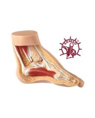 Piede Torto - Modello anatomico SOMSO NS4