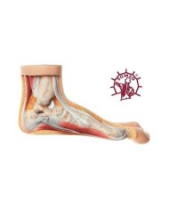 Piede con Alluce Valgo - Modello anatomico SOMSO NS5