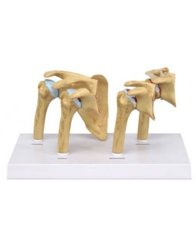 Erler Zimmer, modello anatomico di 4 stadi dell'artrite della Spalla M27