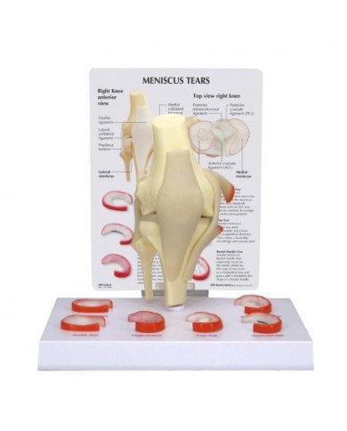 Modello anatomico di menisco con 6 lesioni 3B Scientific 1019500