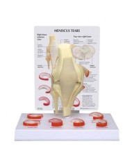 Modello anatomico di menisco con 6 lesioni 3B Scientific 1019500