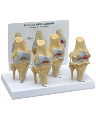 Stadi di osteoartrite dell'articolazione del ginocchio (4 stadi) 3B Scientific 1019502