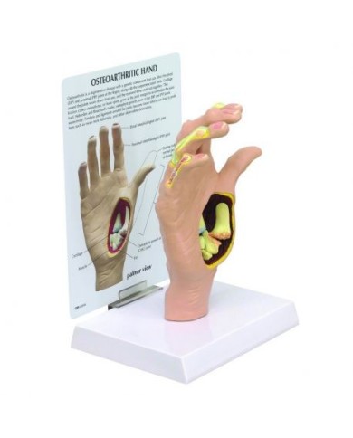 Modello anatomico di mano con osteoartrite 3B Scientific 1019520 Modello anatomico di mano con osteoartrite 3B Scientific 1019520
