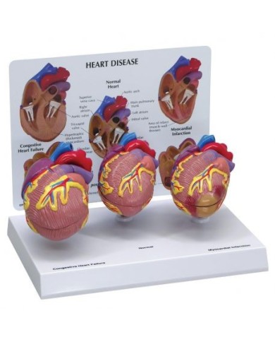 Set didattico, le patologie del cuore, con tre modelli - 3B Scientific 1019530 Set didattico, le patologie del cuore, con tre modelli - 3B Scientific 1019530