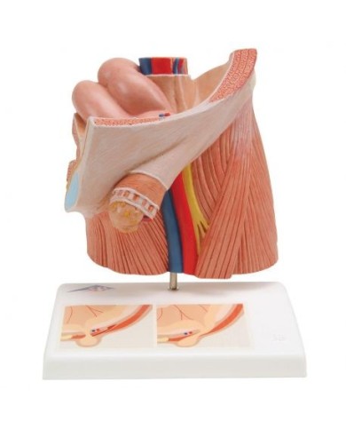 Modello anatomico di ernia inguinale, 3B Scientific H13