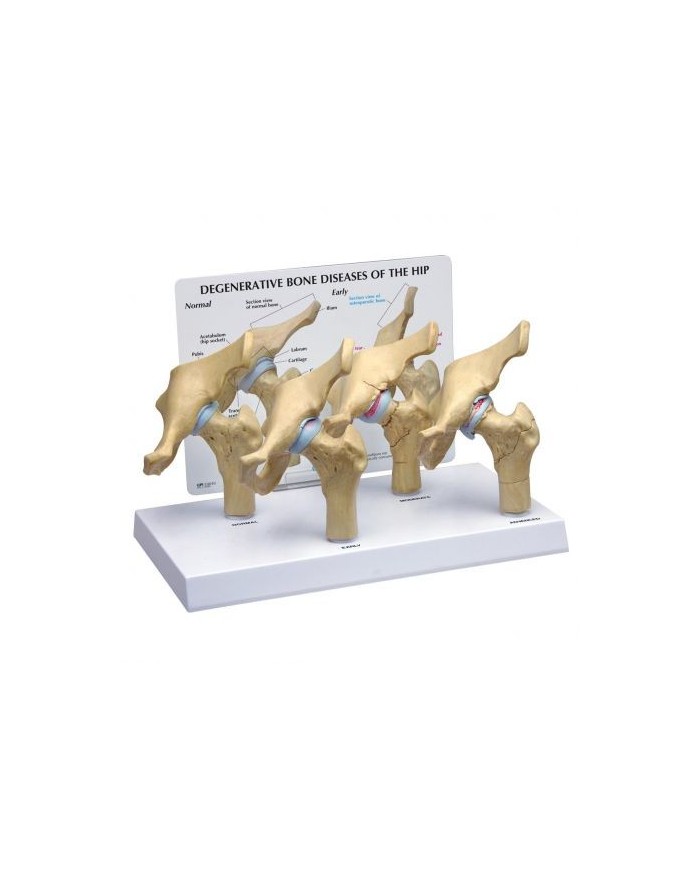 Modello di patologie dell'articolazione dell'anca 3B Scientific 1019506