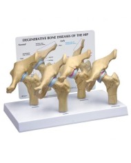 Modello di patologie dell'articolazione dell'anca 3B Scientific 1019506