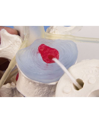 Modello anatomico didattico di vertebre lombari con prolasso, su stand Modello anatomico didattico di vertebre lombari con prolasso, su stand