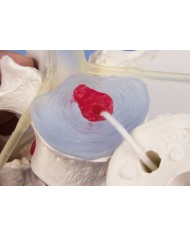 Modello anatomico didattico di vertebre lombari con prolasso, su stand