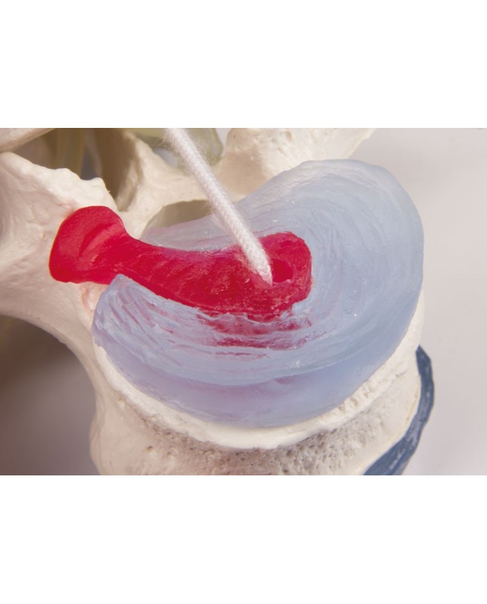 Modello anatomico didattico di vertebre lombari con prolasso, su stand