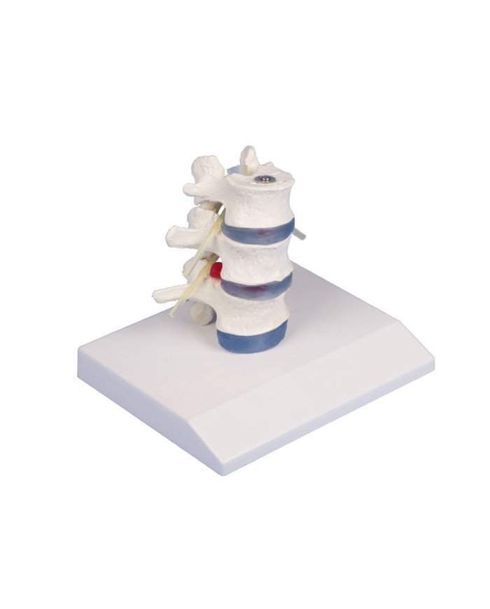 Modello anatomico didattico di vertebre lombari con prolasso, su stand