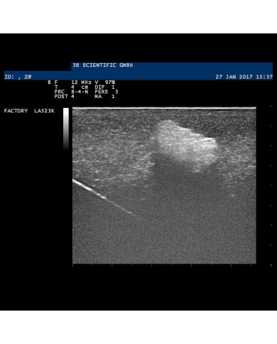 Modello di mammella con tumori SONOtrain P125