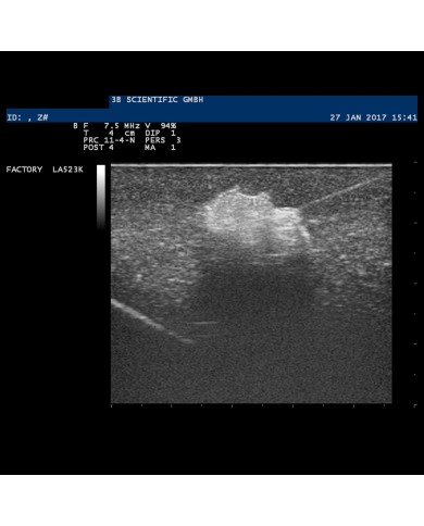 Modello di mammella con tumori SONOtrain P125