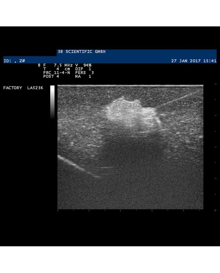 Modello di mammella con tumori SONOtrain P125
