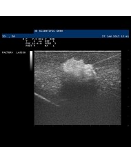 Modello di mammella con tumori SONOtrain P125