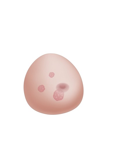 Modello di mammella con tumori SONOtrain P125