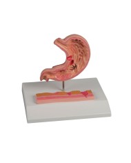 Modello di stomaco con ulcere a dimensioni ridotte EZ K217